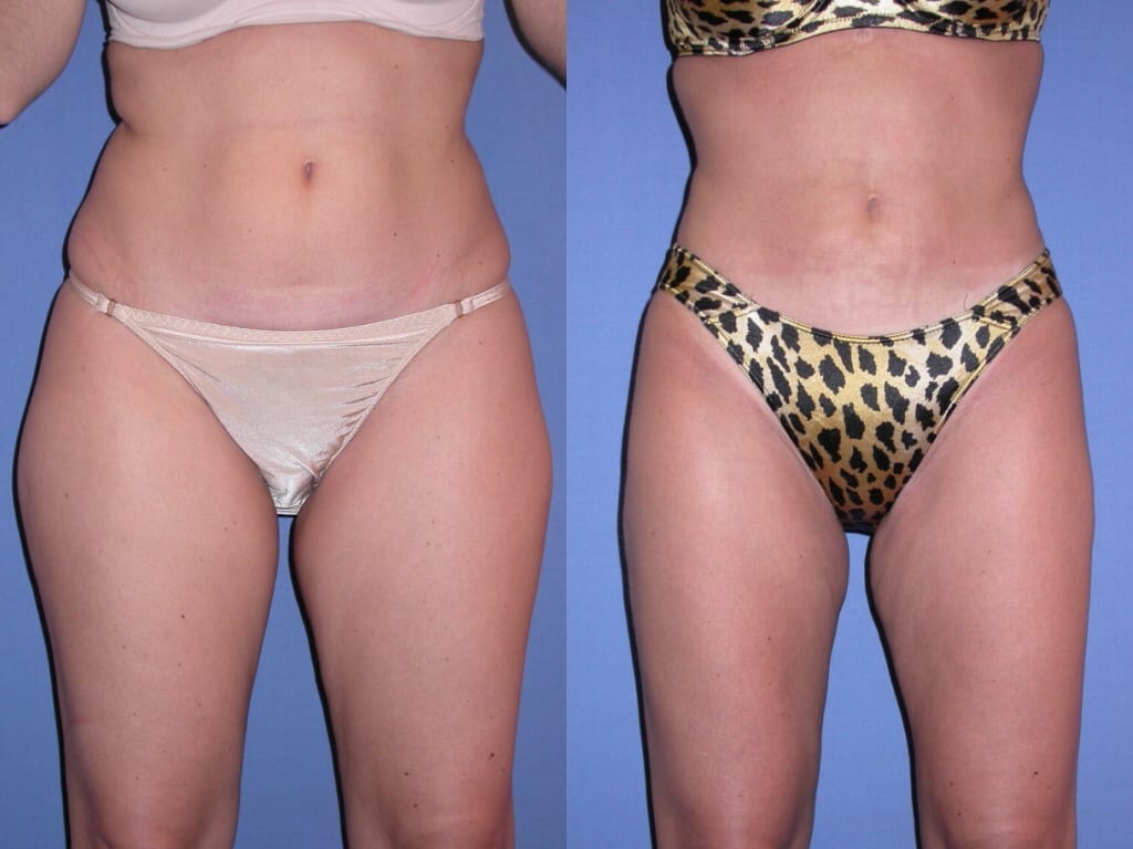 Liposuction of the Love Handles or Flanks Reduce Sides, Love