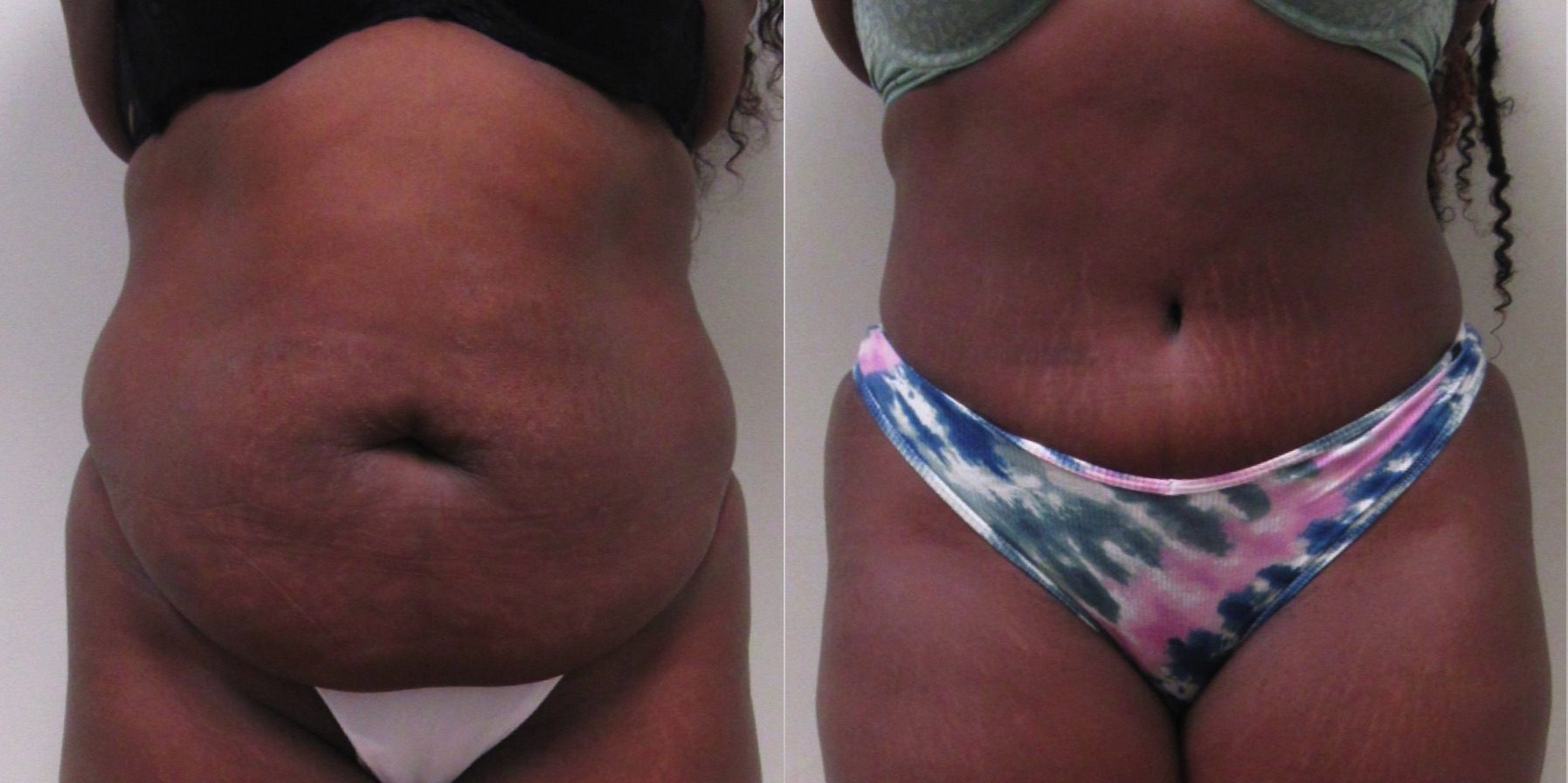 Tummy Tuck Before & After Photos Patient 297, Columbus, OH