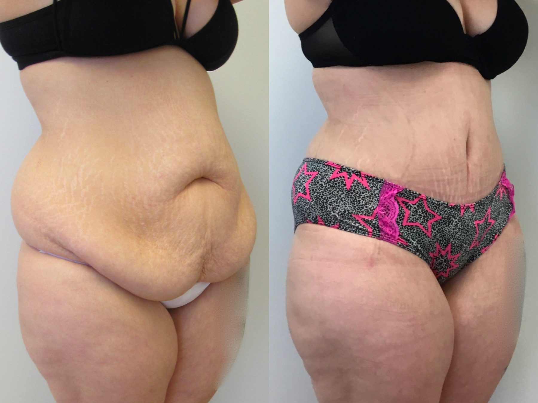 Before & After Abdominoplasty 24 Photos