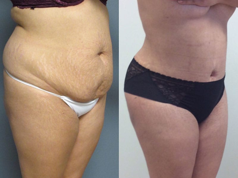 Before & After Tummy Tuck with lipo (3100 cc fat extracted) - Dr
