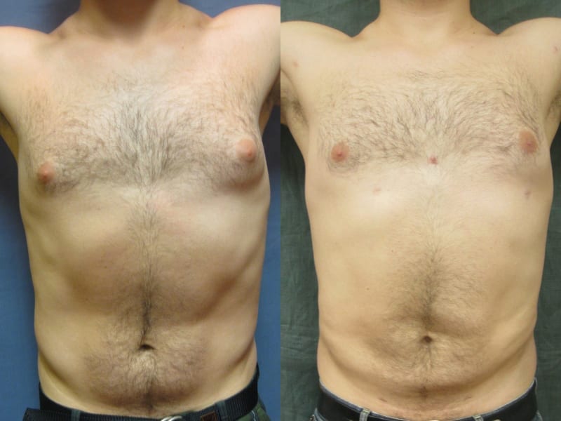 Nipple And Areola Reduction Surgery, Cleveland OH