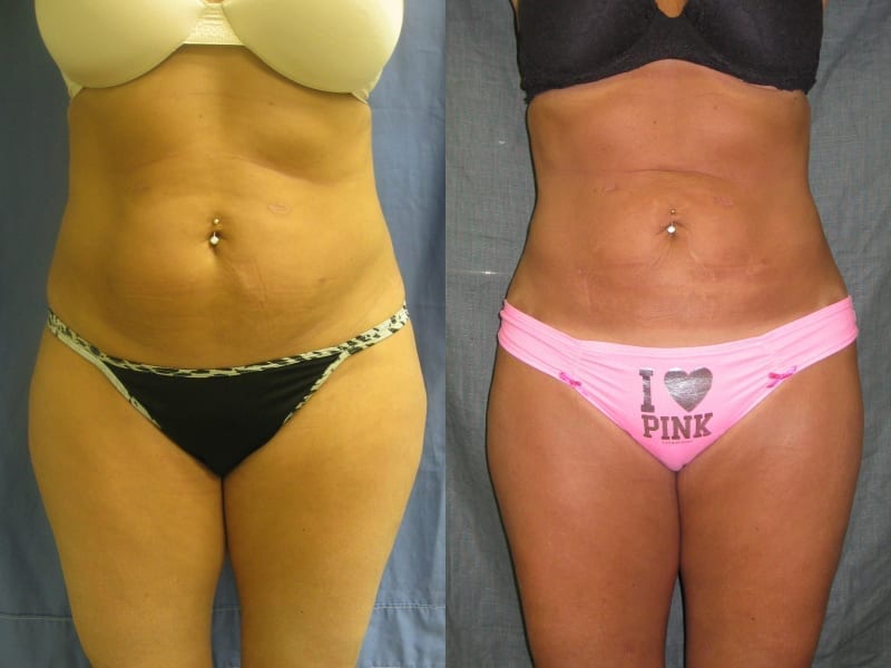 Liposuction Before & After Gallery: Patient 16